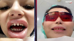 TikTok Dentists Are Warning Against the Viral 'Veneers Check' Trend